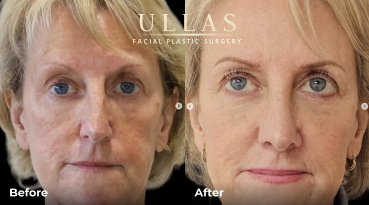 deep plane facelift before after 1