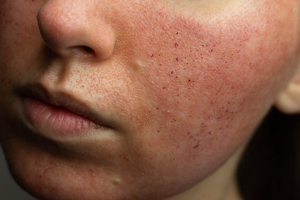 co2 laser resurfacing, co2 laser treatment, co2 fractional laser