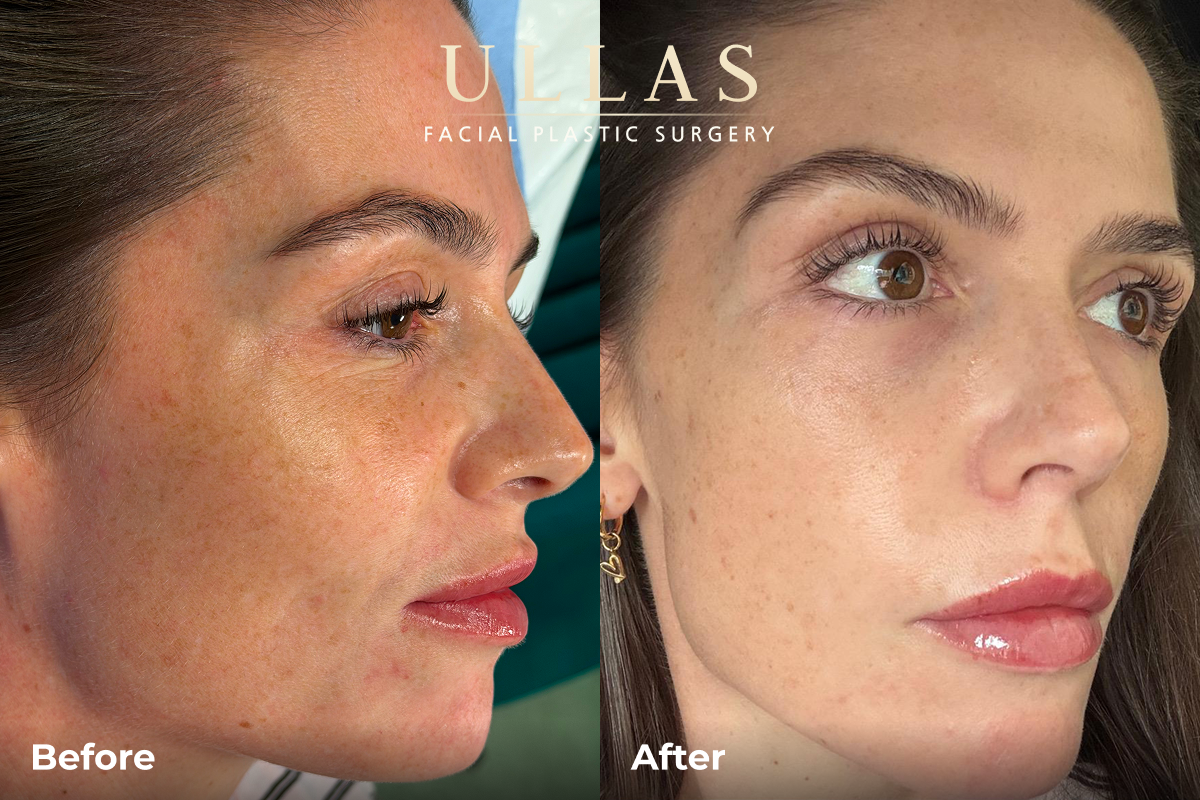 C02 Laser Before and After