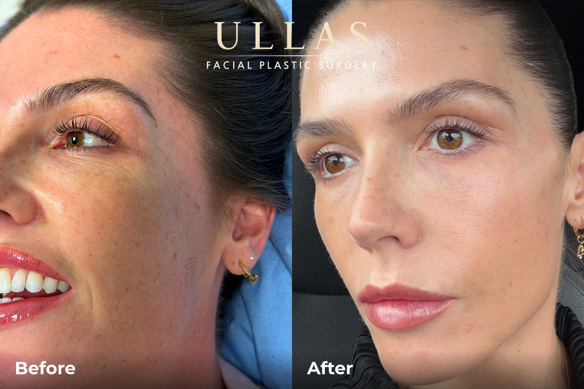 C02 Laser Before and After