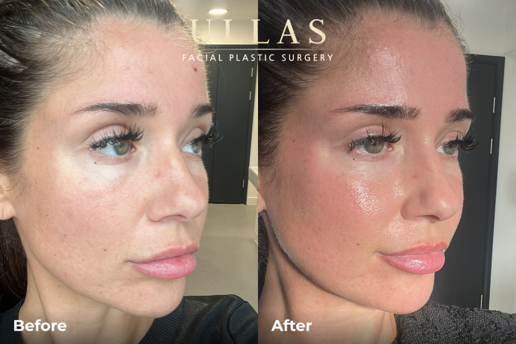 C02 Laser Before and After