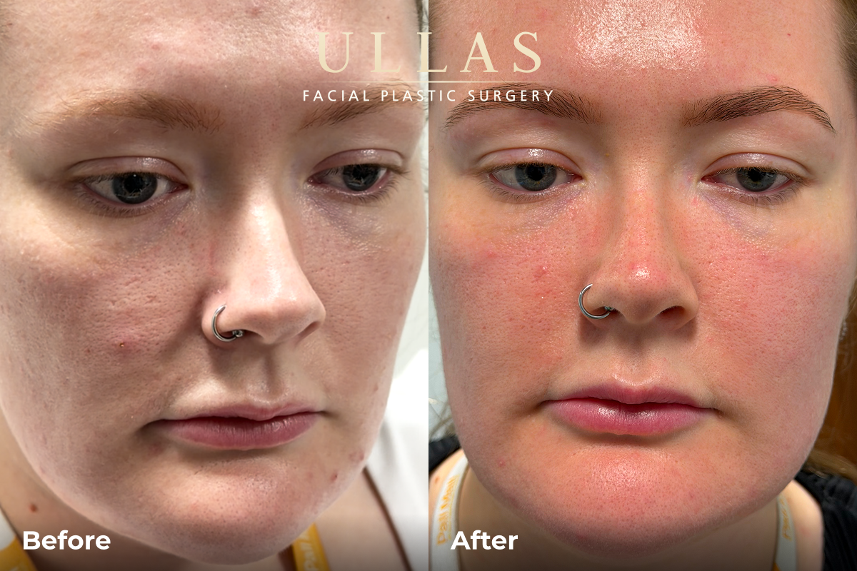 C02 Laser Resurfacing Before and After