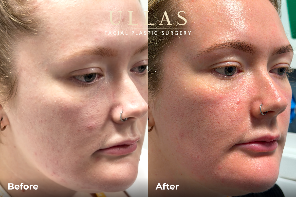 C02 Laser Resurfacing Before and After