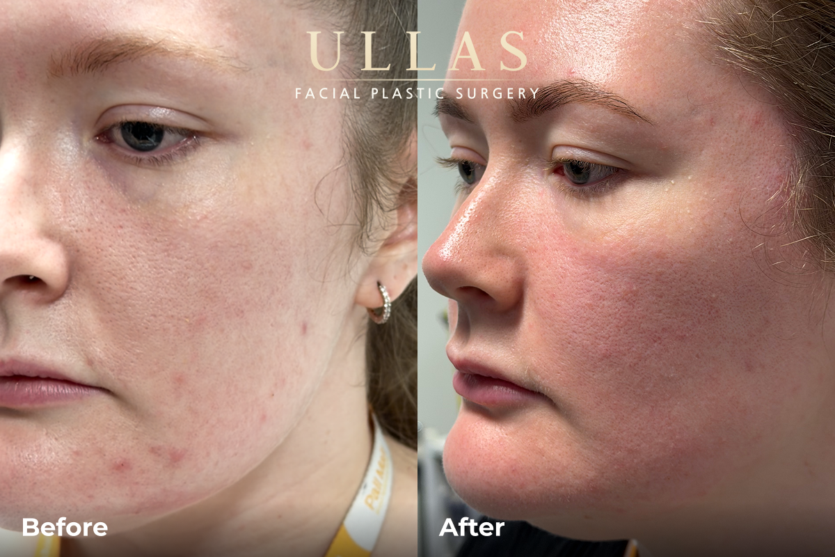 C02 Laser Resurfacing Before and After 3